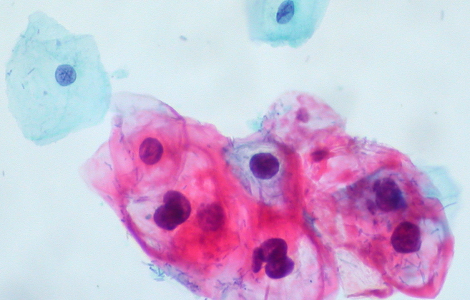 cin-1-hpv-on-thinprep